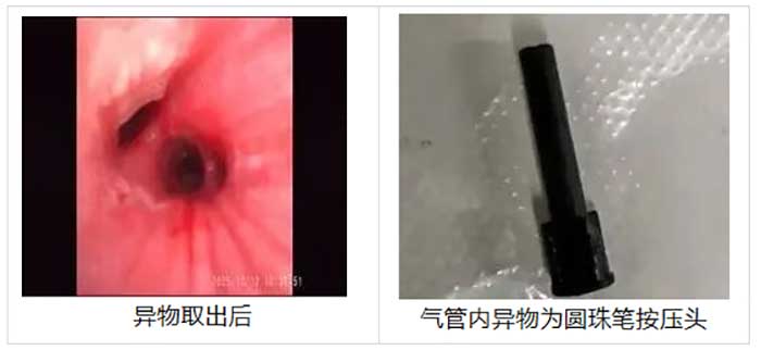 异物取出后.jpg